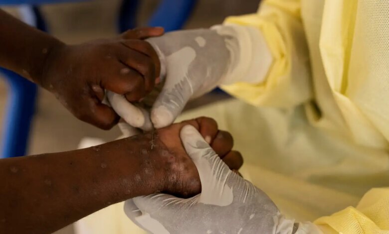 Brasil registra 88 casos de Mpox em 2026; saiba como evitar a doença