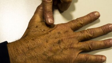 Desinformação sobre câncer de pele afeta diagnóstico, diz instituição