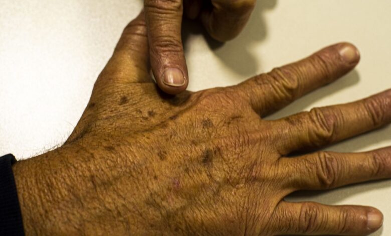 Desinformação sobre câncer de pele afeta diagnóstico, diz instituição