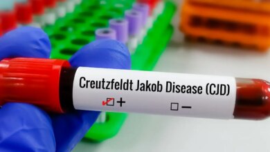 Entenda Doença de Creutzfeldt-Jakob e busca por tratamento