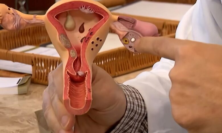 Aberta chamada pública para pesquisas sobre endometriose