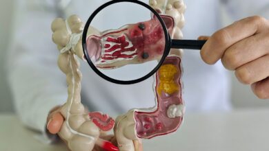 Em 13 anos, doença inflamatória intestinal cresce 5 vezes no Brasil