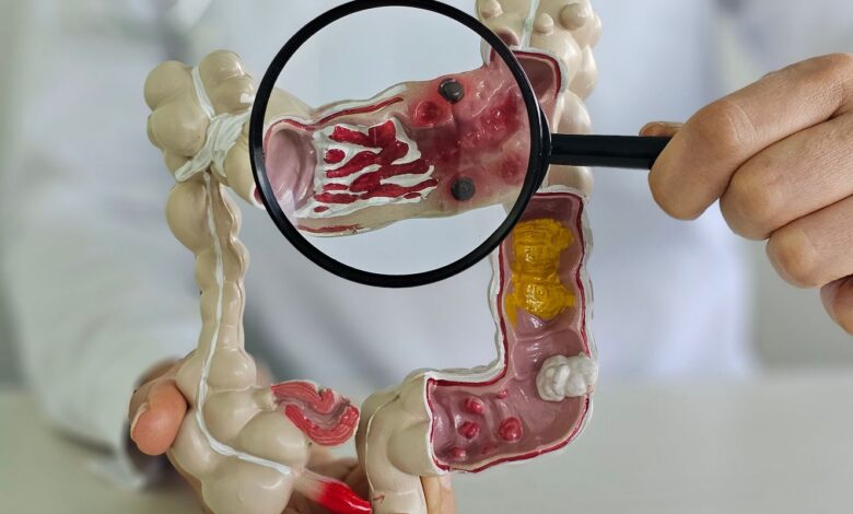 Em 13 anos, doença inflamatória intestinal cresce 5 vezes no Brasil
