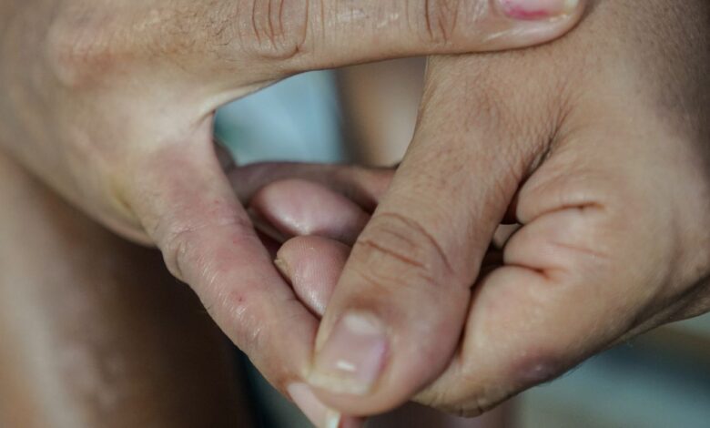 Dermatite atópica impacta pele, sono e autoestima: saiba como tratar