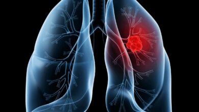 Saiba o que é adenocarcinoma pulmonar, câncer que atinge o Papa Leão