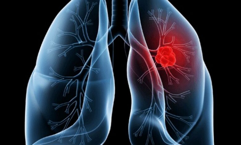 Saiba o que é adenocarcinoma pulmonar, câncer que atinge o Papa Leão